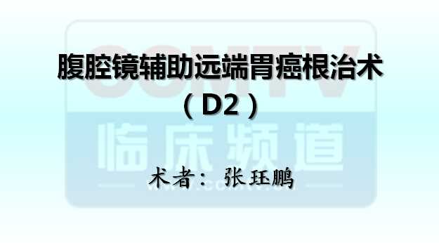 张珏鹏：腹腔镜辅助远端胃癌D2根治术（含讲解）