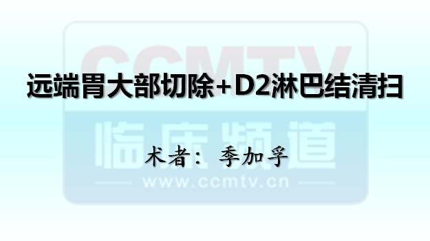 季加孚：远端胃大部切除+D2淋巴结清扫