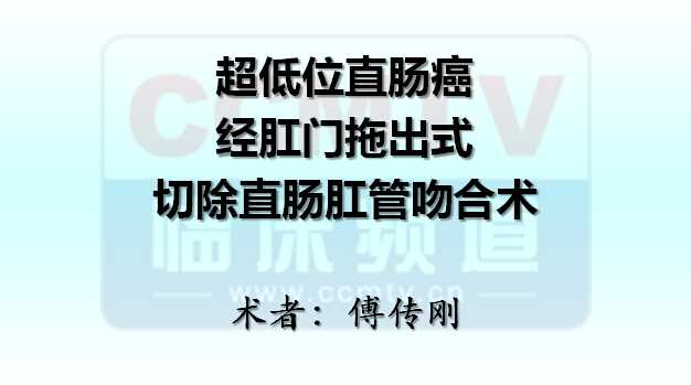 傅传刚：超低位直肠癌经肛门拖出式切除直肠肛管吻合术