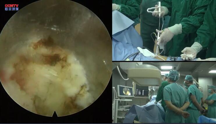 张西峰：脊柱内镜下腰椎间盘髓核摘除术