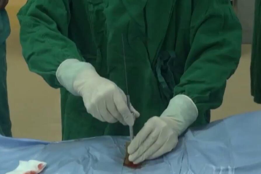张西峰：腰5骶1椎间盘突出 - 经皮椎间板入路脊柱内镜下髓核摘除术