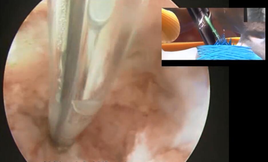 于峥嵘：腰3-骶1多段椎间盘突出 - 椎间孔镜下腰椎间盘摘除术