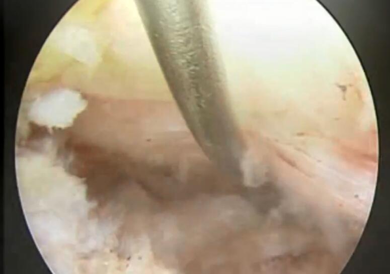 于峥嵘：椎间孔镜下腰椎间盘摘除术