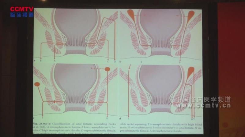 段宏岩：基于影像学的肛瘘诊治进展及经验