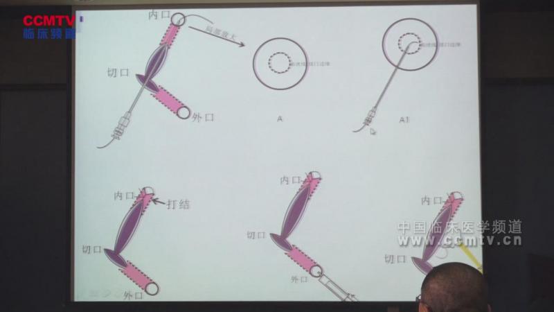李东冰：跳跃式接力切开短程挂线+脱细胞真皮治疗复杂肛瘘