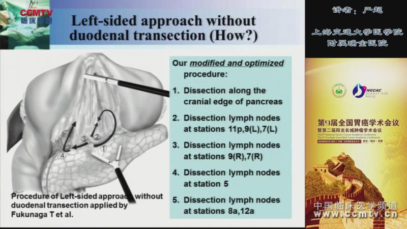 严超：腹腔镜胃癌根治术左侧入路胰腺上缘淋巴结清扫