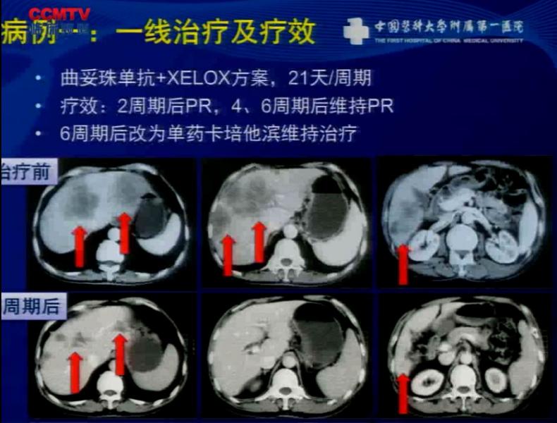 刘云鹏：胃癌化疗的个体化策略