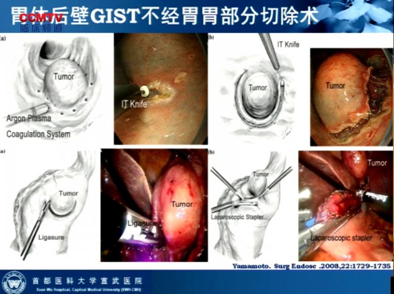 李非：胃GIST腹腔镜治疗方式的探讨（方育教授代讲）
