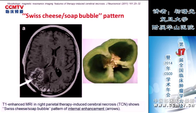 初曙光：神经肿瘤的影像诊断及脑肿瘤治疗后的影像学评价