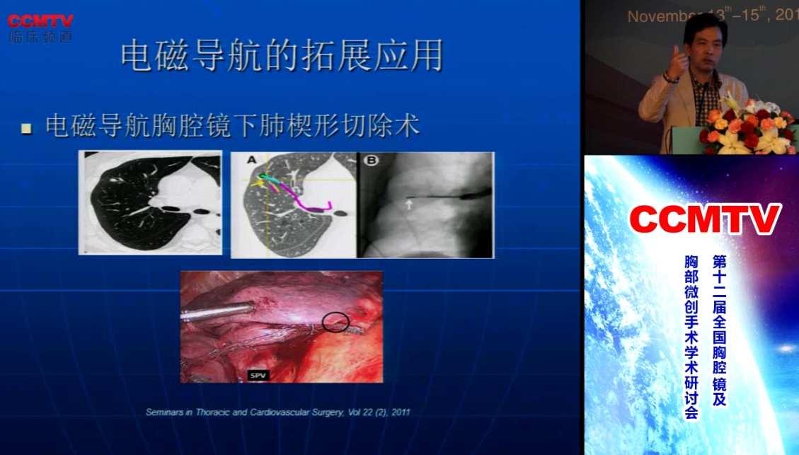 杨胜生：导航支气管镜的临床应用