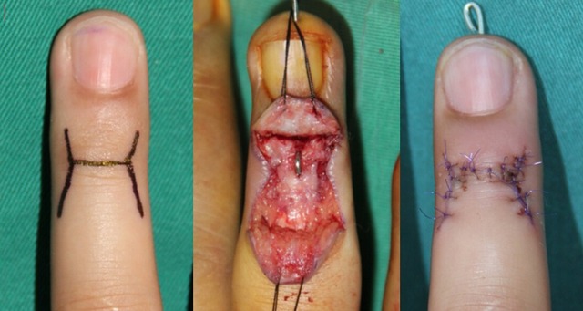 2007 年 6 月至 2014 年 3 月共有 41 名锤状指骨折患者接受上述手术