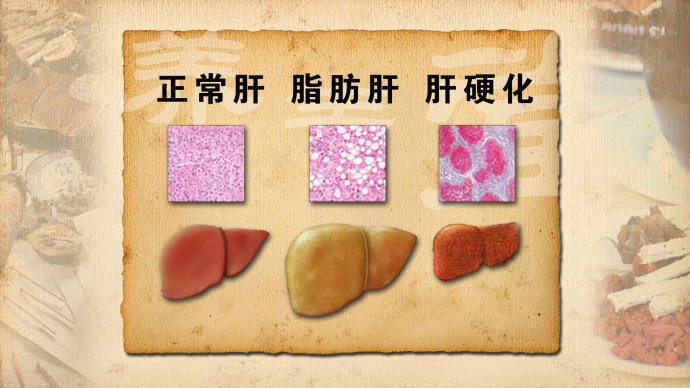 非酒精性脂肪肝(nafld)表型的转归研究