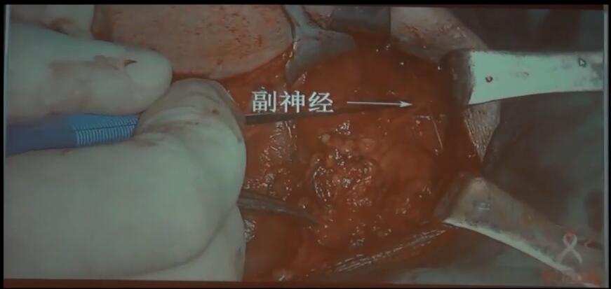 吴高松：甲状腺癌侧颈区淋巴结筋膜解剖性切除