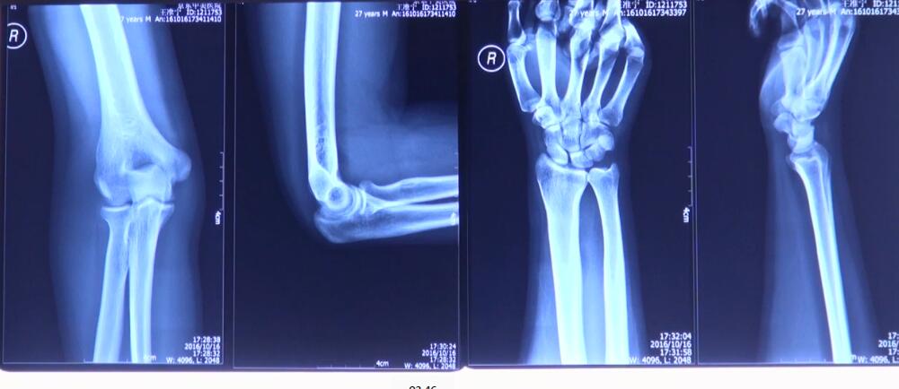 北医三院：手臂软组织损伤，无脱位病例的处理