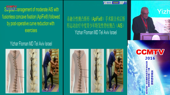 非融合性侧凸矫形手术联合术后矫形运动治疗中度青少年特发性脊柱侧凸（AIS）