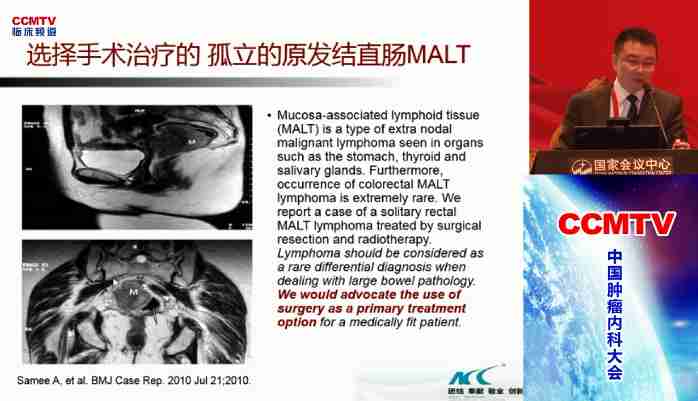 刘鹏：原发胃肠道淋巴瘤的MDT