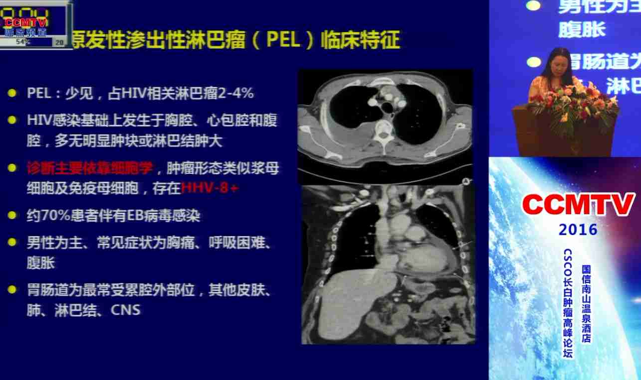 张清媛：CD20阴性弥漫大B细胞淋巴瘤诊疗进展