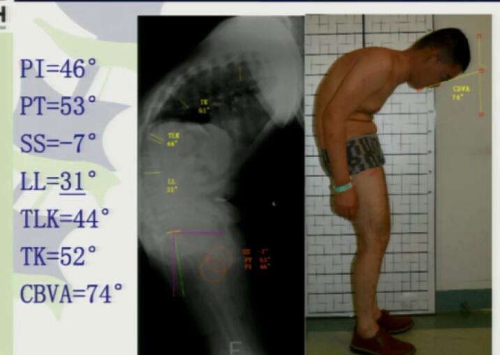 王征：强直性脊柱炎后凸畸形整体解决方案+手术