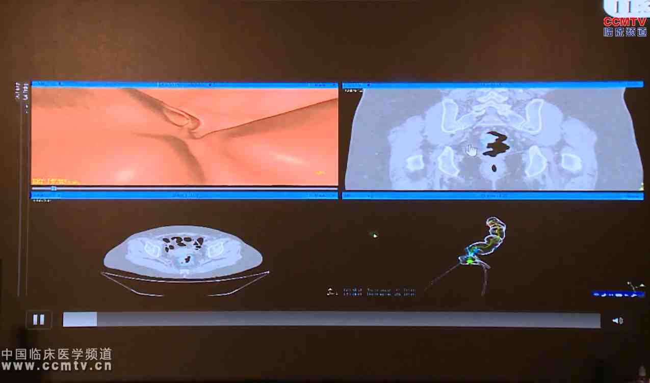 Y Lu：虚拟内窥镜工作站的开发及在胃肠肿瘤研究中的准确定位