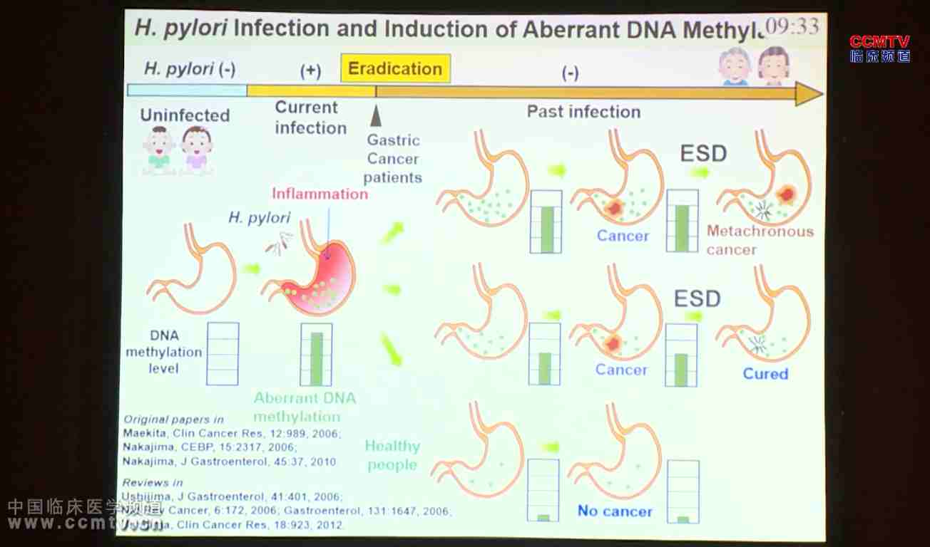 M Maeda：甲基化积累对异时胃癌的影响（多中心前瞻列队研究5年随访）