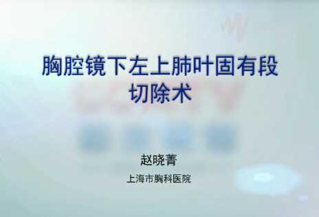 赵晓菁：胸腔镜下左上肺叶固有段切除术
