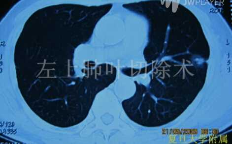 陈海泉：左上肺叶切除术