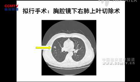 初向阳：单操作孔胸腔镜下右肺上叶切除术