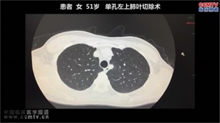 傅于捷：单孔左肺上叶切除术