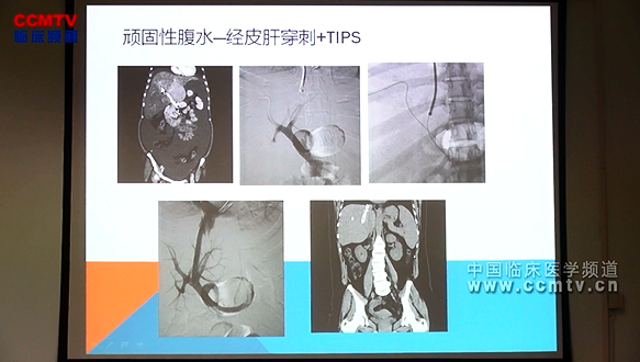 刘福全：TIPS技术与围手术期安全性分析2005例