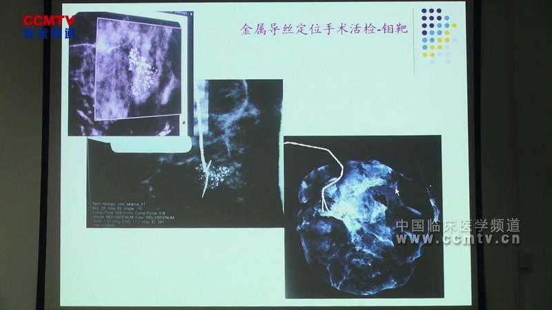 李艳萍：什么样的乳腺病变需要手术治疗