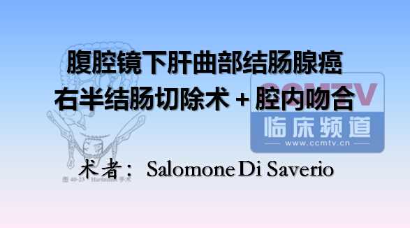 SD Saverio：腹腔镜下肝曲部结肠腺癌右半结肠切除术＋腔内吻合（2）