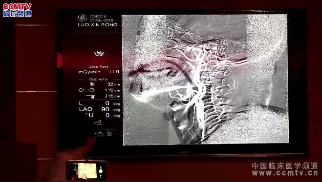 万杰清：颈动脉支架手术置入（含讲解）