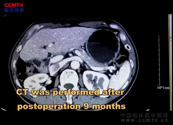 何军明：腹腔镜下完全半肝血流阻断右半肝切除术