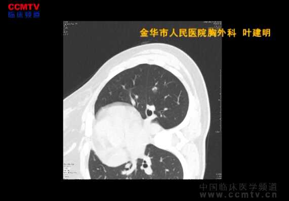 叶建明：疑似恶性结节患者左肺下叶切除