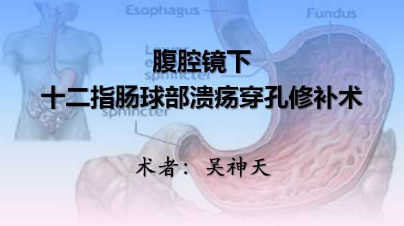 吴神天：腹腔镜十二指肠球部溃疡穿孔修补术