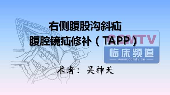吴神天：腹腔镜疝修补TAPP