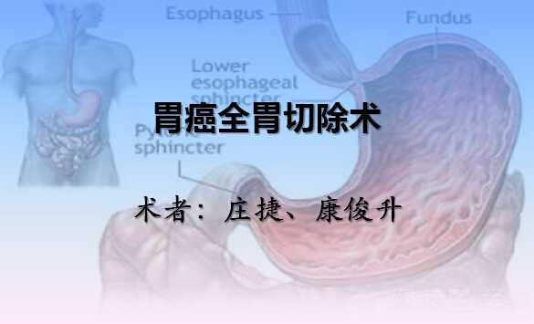 庄捷、康俊升：胃癌全胃切除术（开放） - 下