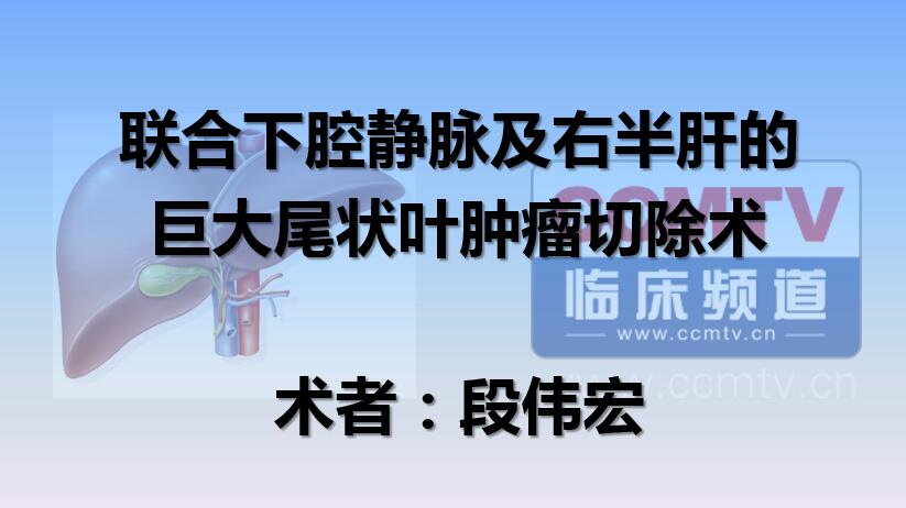 段伟宏：联合下腔静脉及右半肝的巨大尾状叶肿瘤切除术