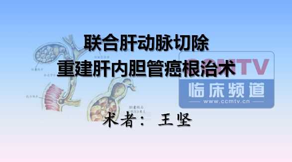 王坚：联合肝动脉切除重建肝内胆管癌根治术