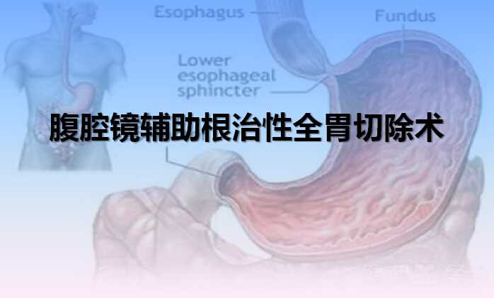 腹腔镜辅助根治性全胃切除术