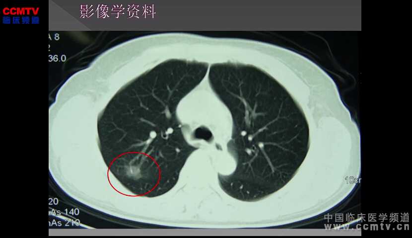 贾卓奇：胸腔镜下肺右上叶癌根治术