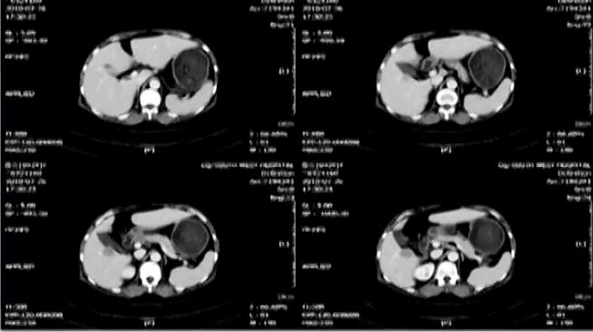 郑树国：腹腔镜下解剖性右半肝切除术