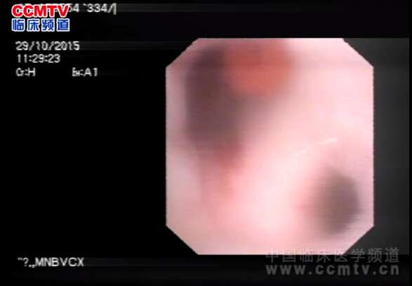 鲁军：肾盂结石-钬激光软镜碎石术