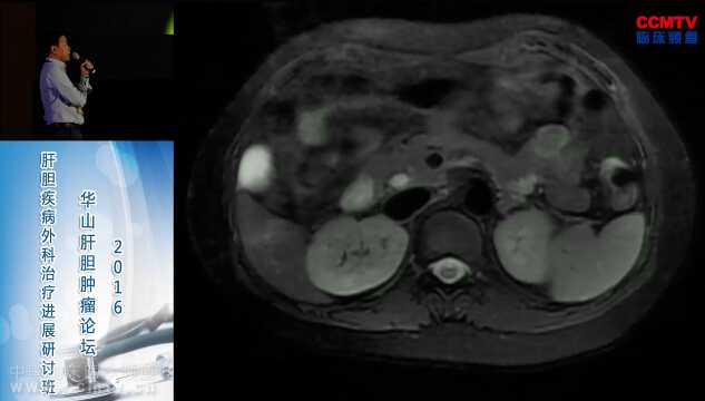 柏斗胜：腹腔镜下左半肝切除，胆囊切除，胆总管切开取石术（含讲解）