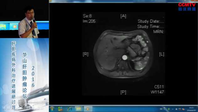 王祖森：腹腔镜左半肝切除术（含讲解）