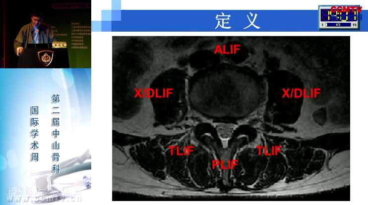 姜晓辛：XLIF在腰椎手术中的应用