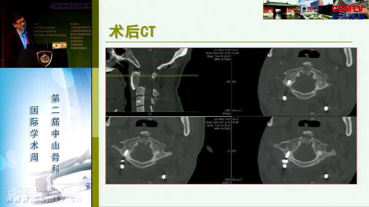 赵杰：经下颌骨入路行颈椎肿瘤外科切除术