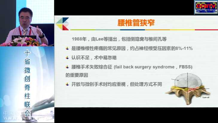 史建刚：腰椎管退变性疾病的神经根减压：椎间孔镜&开放手术