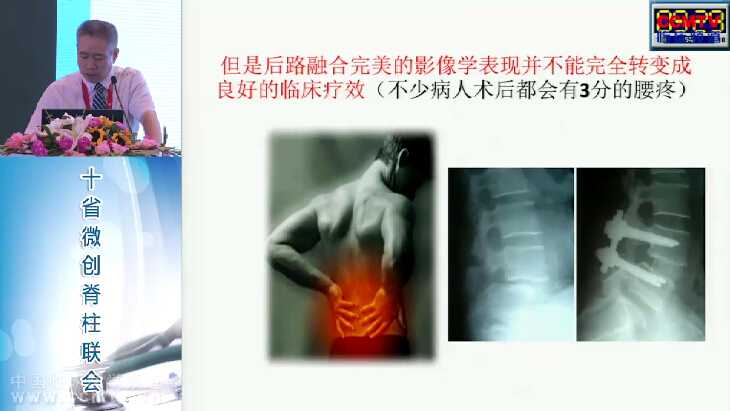 范顺武：腰椎间侧前方融合的临床应用与意义