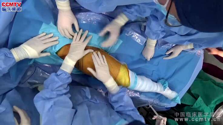 蔡郑东：骨盆软骨肉瘤切除术+人工半骨盆置换术